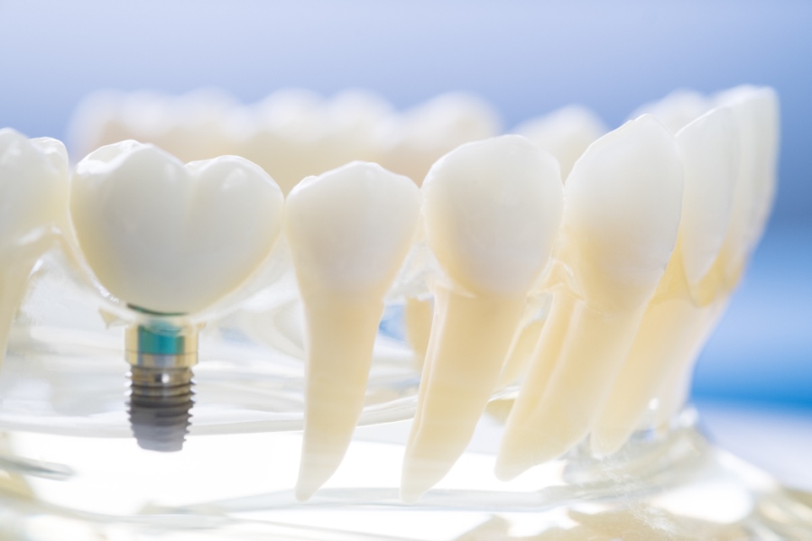 implantat